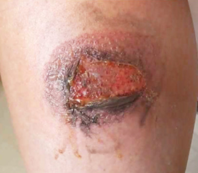 Instructions for taking care of sores caused by motorbike burns