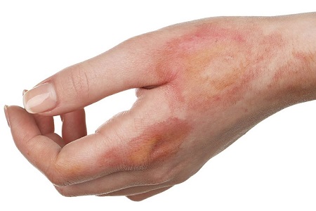 Foods to avoid after a burn injury?