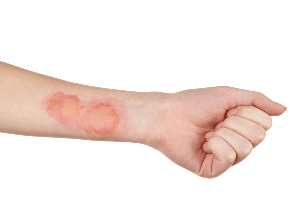 How to prevent scarring from burns?