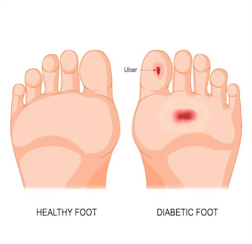 Foot problems in diabetes