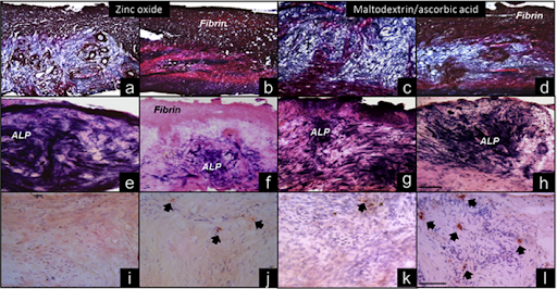 Maltodextrin/ ascorbic acid stimulates wound closure by increasing collagen turnover and TGF-β1 expression in vitro and changing the stage of inflammation from chronic to acute in vivo