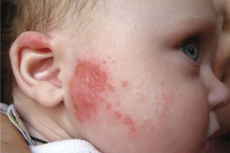 Điều trị bệnh viêm da dị ứng và bệnh chàm ở trẻ em