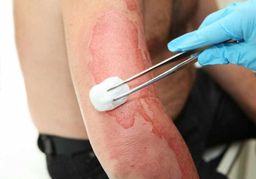 Treatment of burns caused by electrical equipment