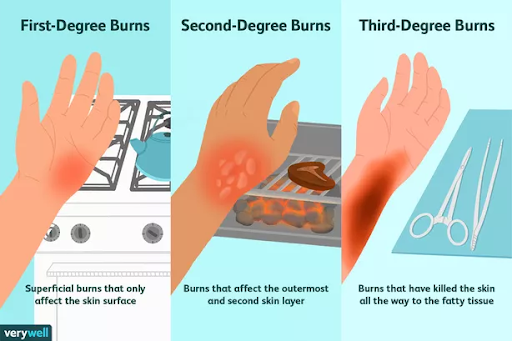 Recognition and first aid for 3 degree burns