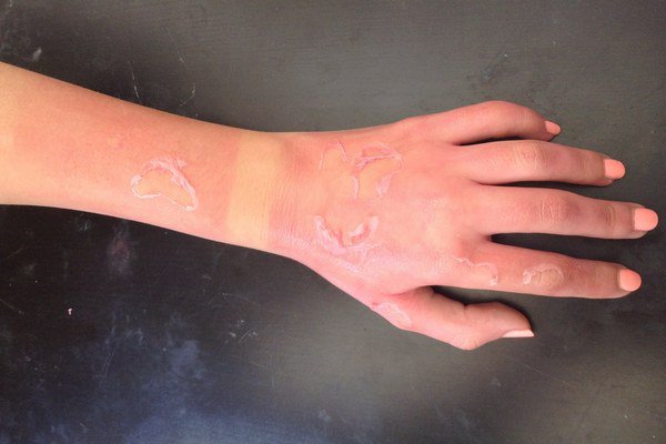 Second-degree burn: Everything you need to know