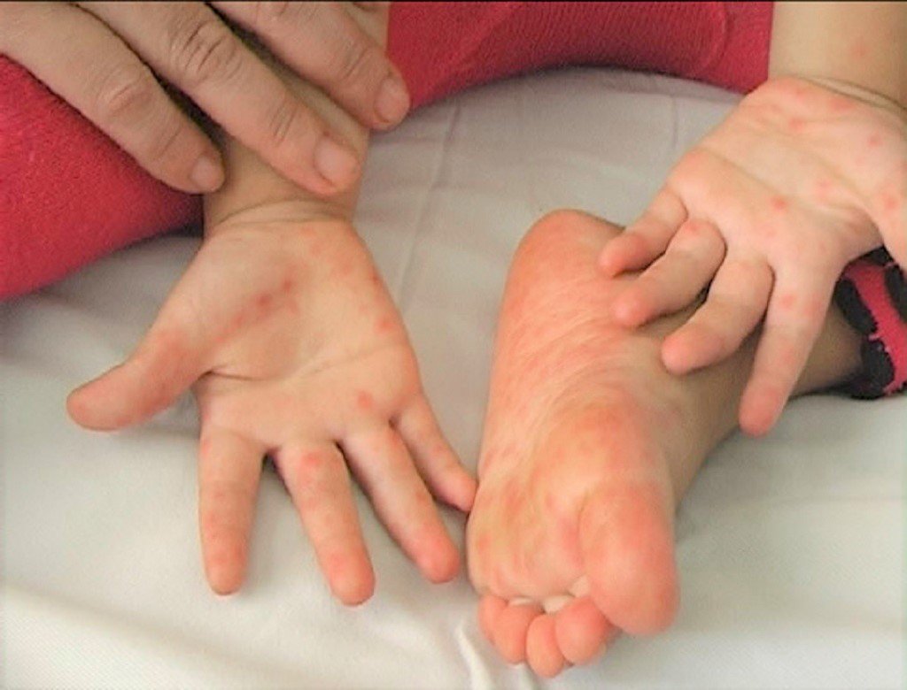 Caring for children with hand, foot and mouth disease