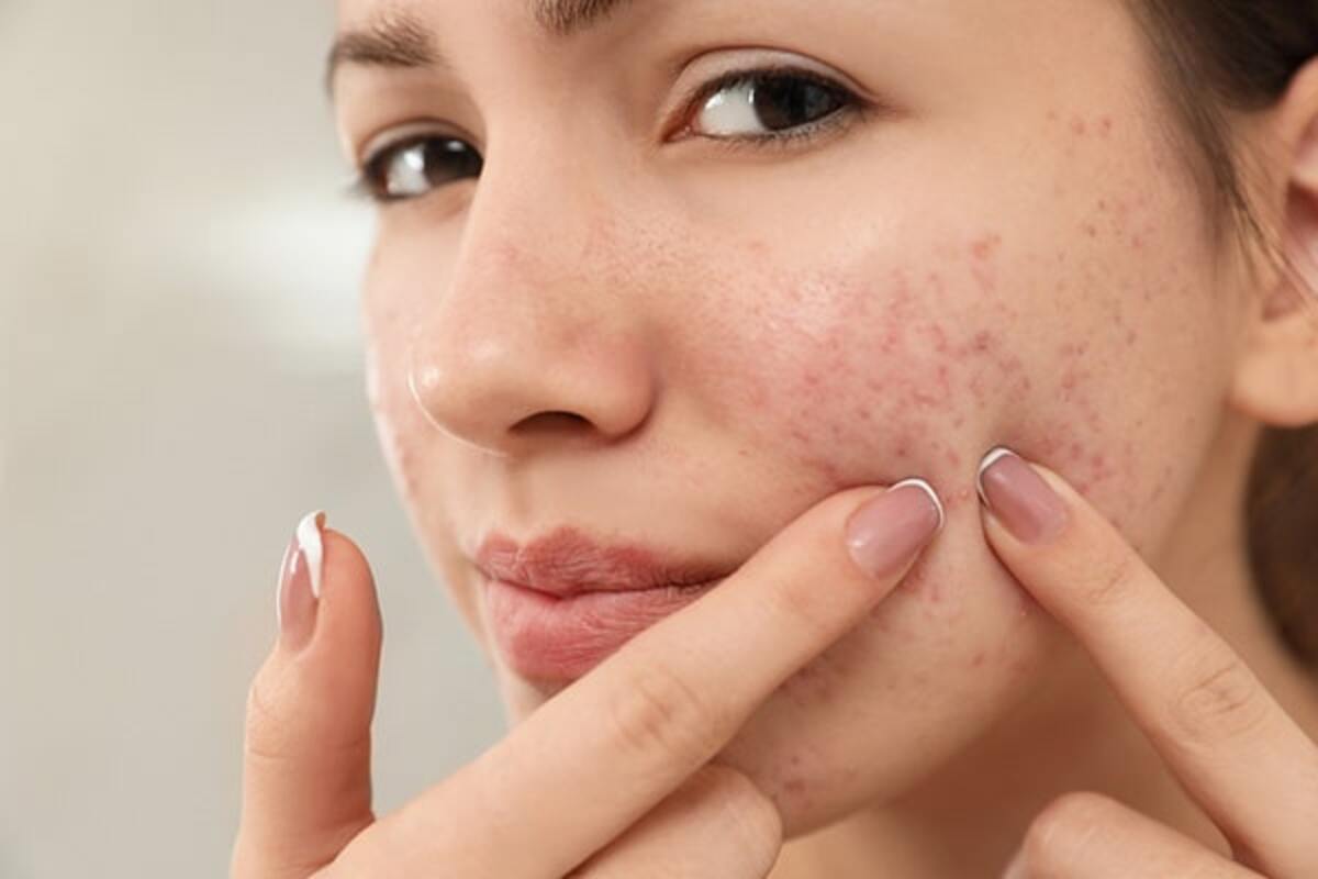 Is it easy to treat acne?