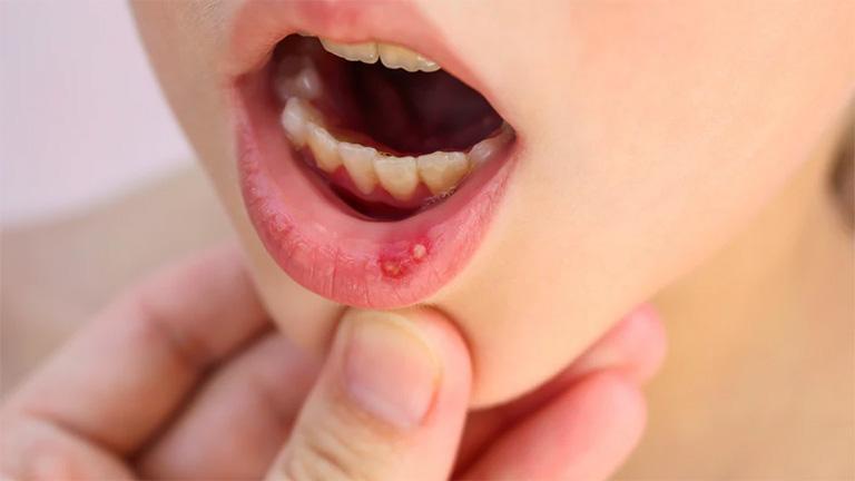 Can mouth ulcers be treated at home?