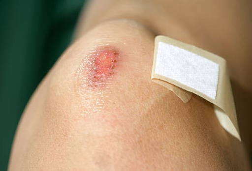 Common wound care myths