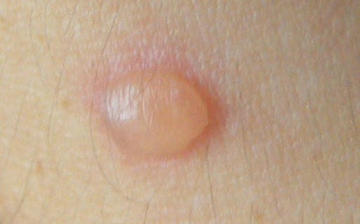 Recognizing blisters on the skin and how to treat it