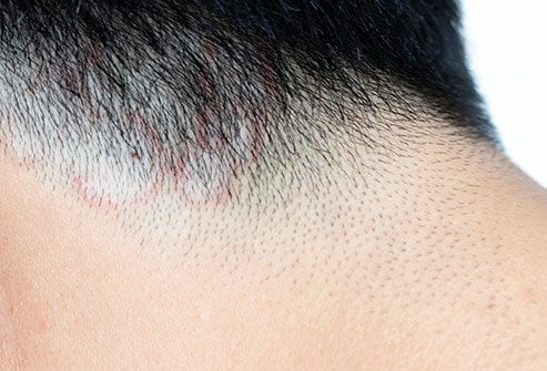 Symptoms and Causes of Ringworm of the scalp