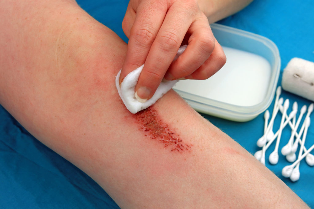 10 Myths about Wound Healing